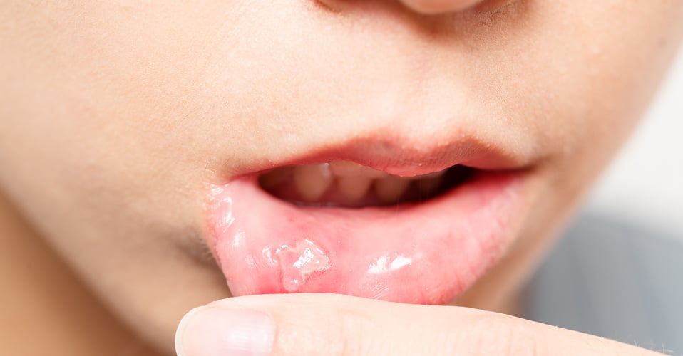 ulcera bucal tratamiento
